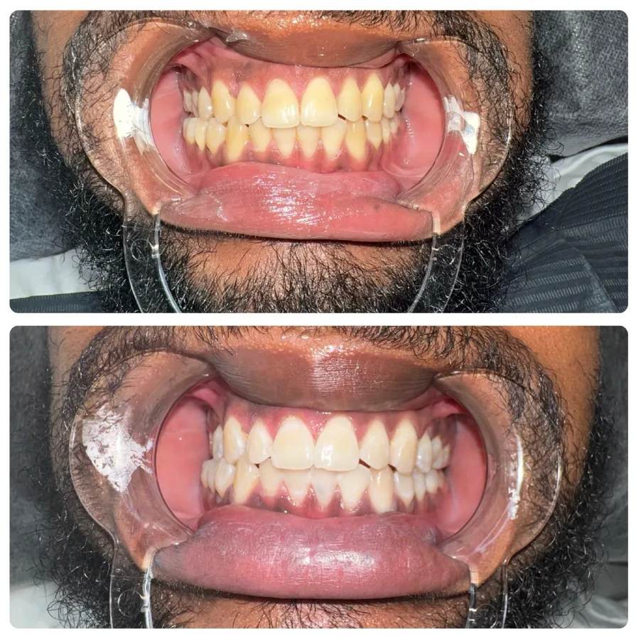 Before and after comparison of a client's teeth after professional LED whitening at Lumen in the South Bronx