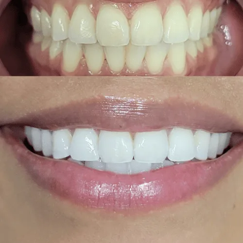 Client smiling with noticeably whiter teeth after a Lumen teeth whitening session
