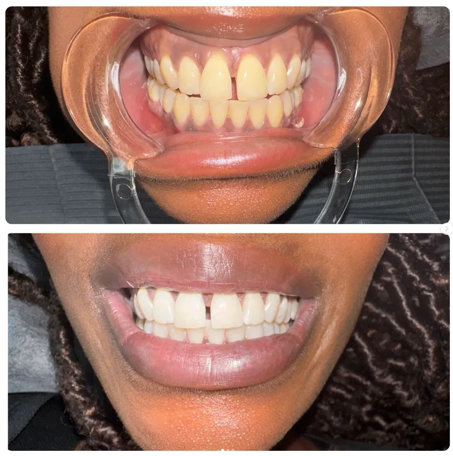 Close-up of brighter, whiter teeth following an in-person whitening treatment at Lumen, Bronx NY