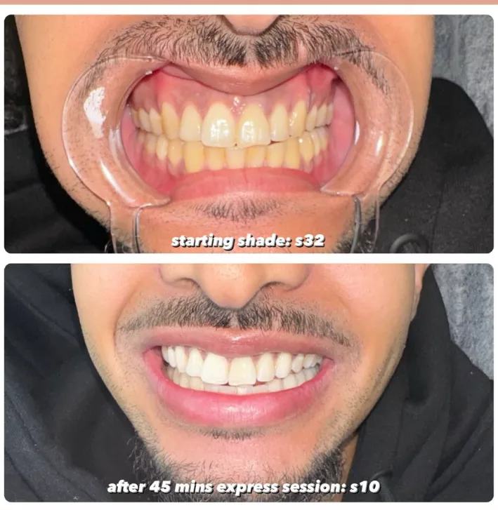 Teeth whitening result showing several shades of improvement after one visit to Lumen