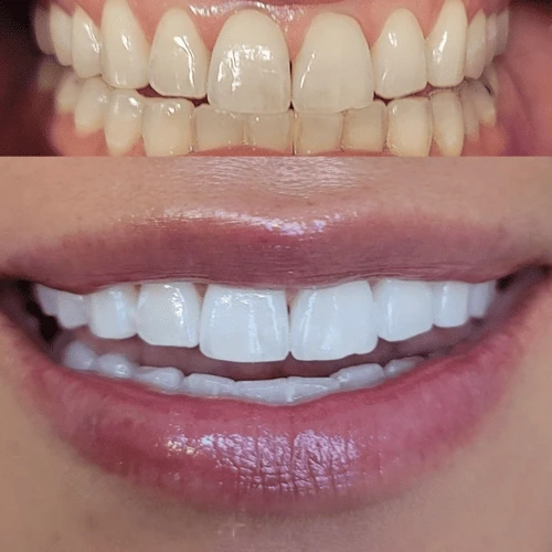 A confident white smile after professional cosmetic teeth whitening at Lumen near Yankee Stadium