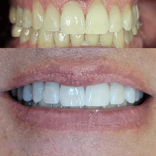 Bright, even smile after an enamel-safe LED whitening session at Lumen studio